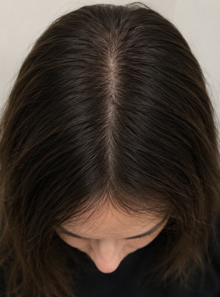 After Red Light Therapy, hair comparison